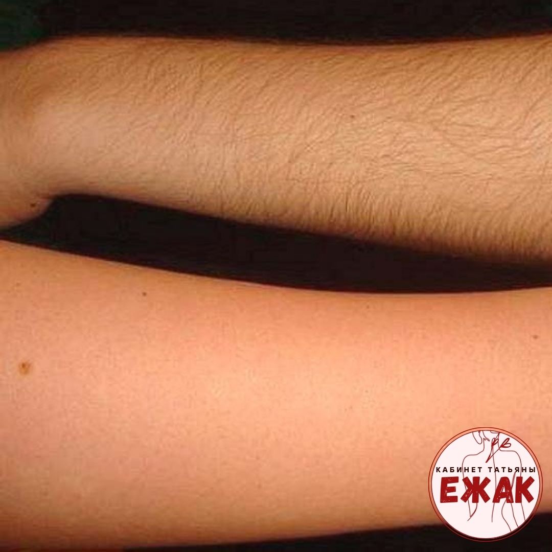 Депиляция результат 2