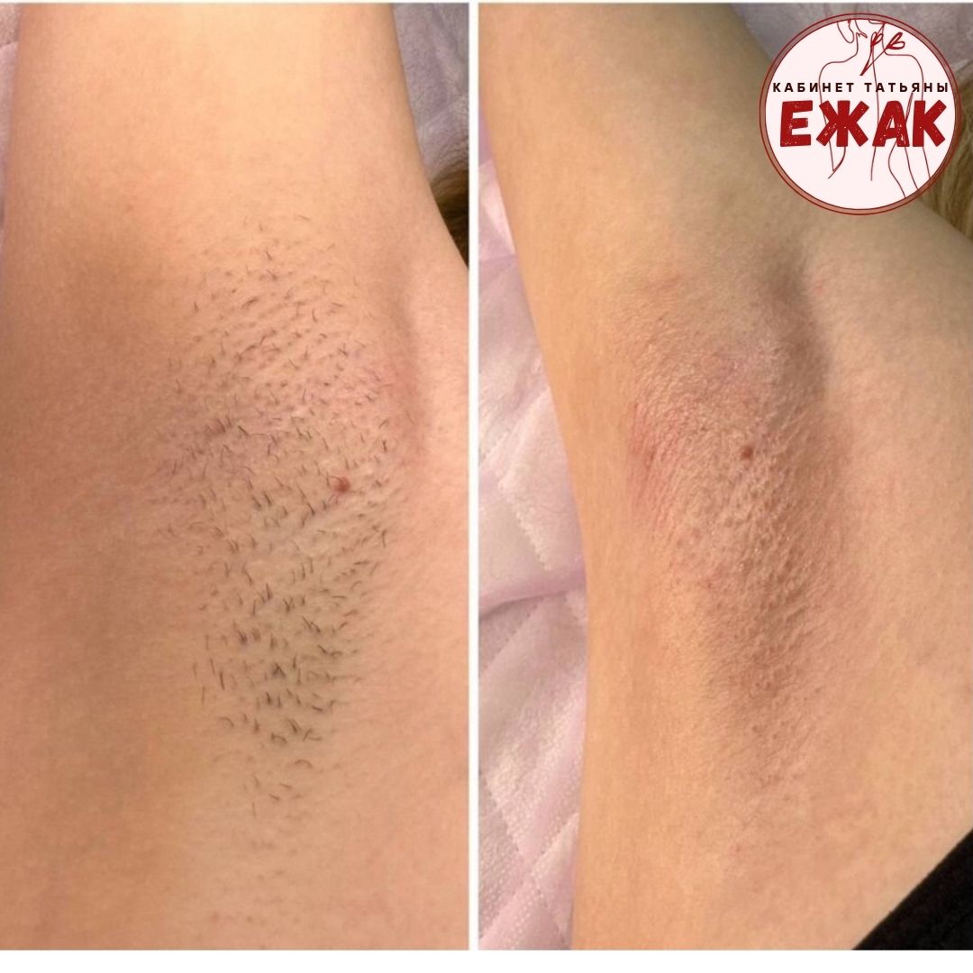 Депиляция результат 3