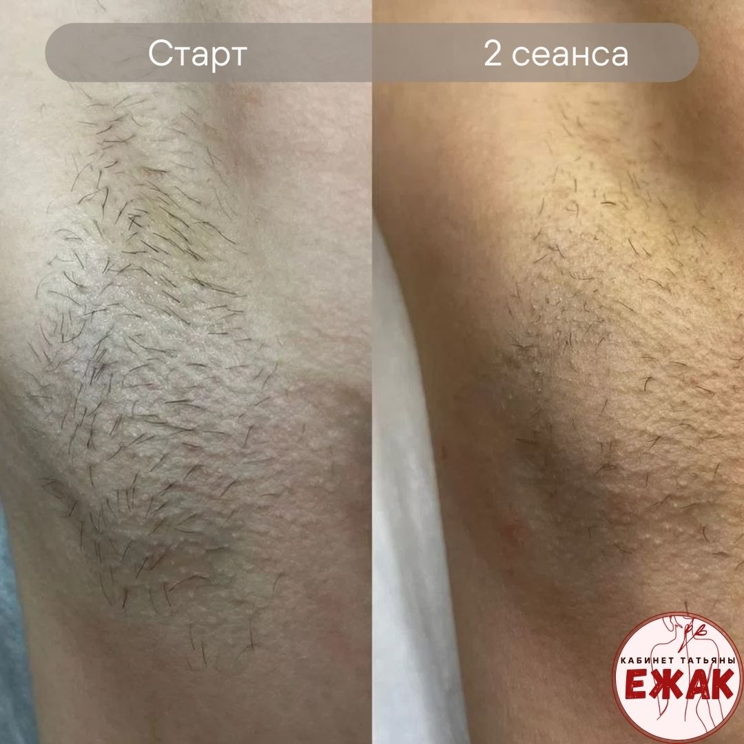 Электроэпиляция результат 1