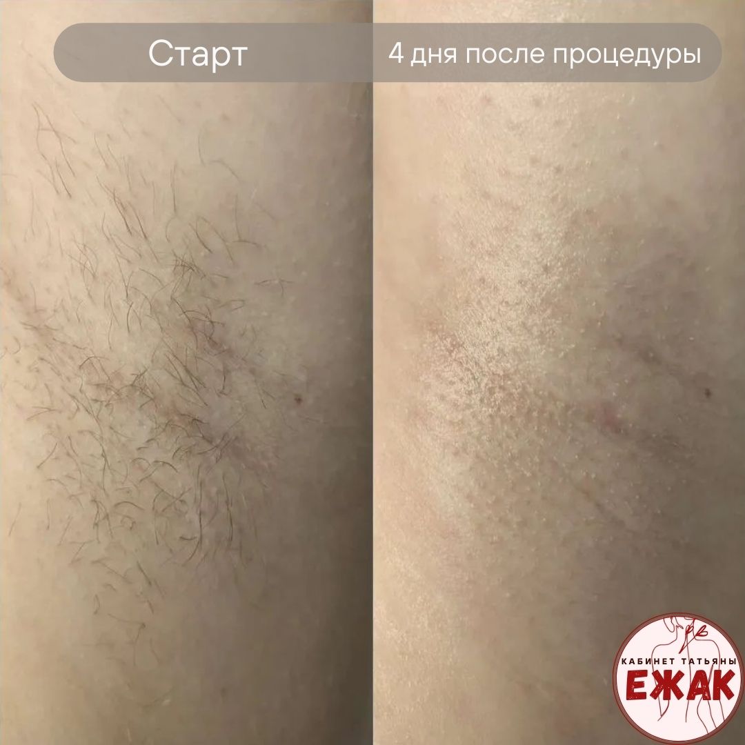 Электроэпиляция результат 2