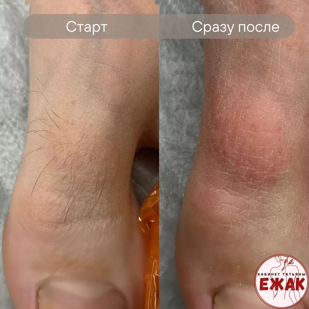 Электроэпиляция результат 3